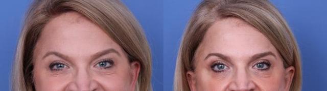 Blepharoplasty result at Todd Hobgood, MD in Scottsdale, AZ