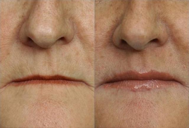 Chin Implant result at Todd Hobgood, MD in Scottsdale, AZ