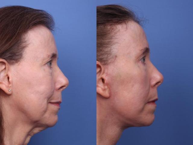 Neck Lift result at Todd Hobgood, MD in Scottsdale, AZ
