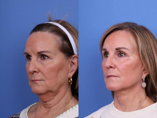 Brow Lift result at Todd Hobgood, MD in Scottsdale, AZ