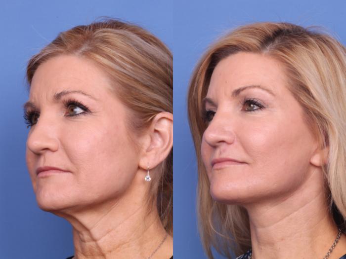 Todd Hobgood, MD liposuction result — Scottsdale, AZ