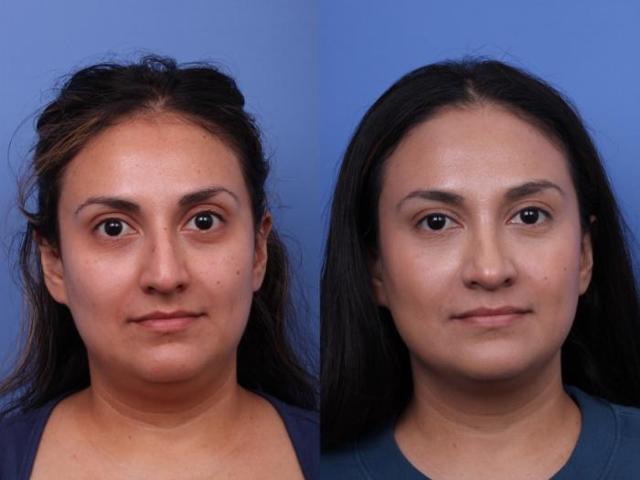 Rhinoplasty result at Todd Hobgood, MD in Scottsdale, AZ