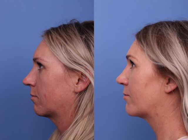 Chin Implant result at Todd Hobgood, MD in Scottsdale, AZ