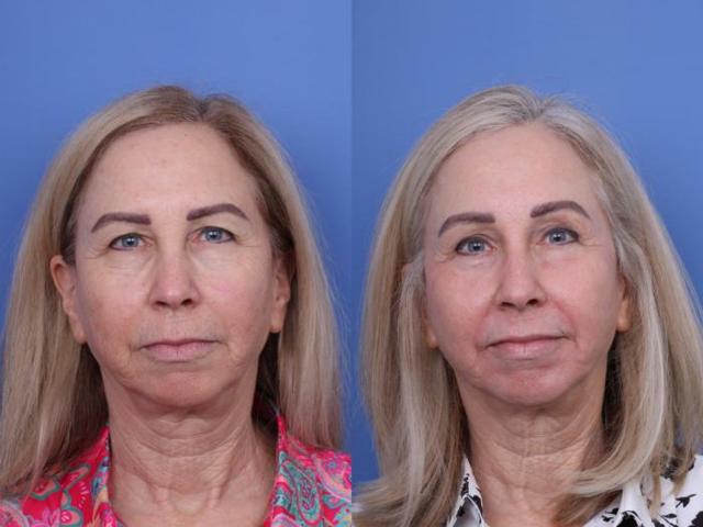 Blepharoplasty result at Todd Hobgood, MD in Scottsdale, AZ