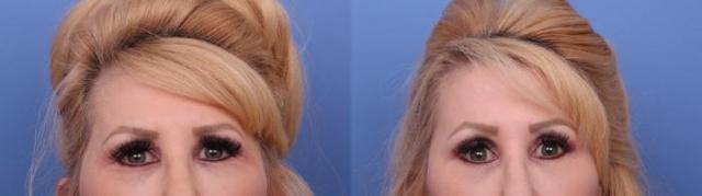 Brow Lift result at Todd Hobgood, MD in Scottsdale, AZ
