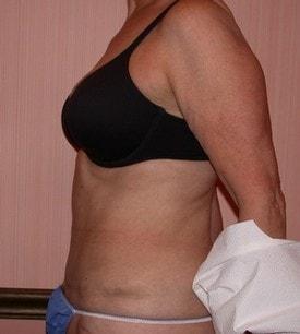 Tummy Tuck after at Christopher V. Pelletiere, MD in Inverness, IL