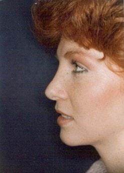 Christopher V. Pelletiere, MD rhinoplasty after — Inverness, IL