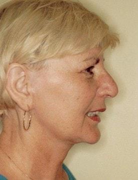 Christopher V. Pelletiere, MD facelift after — Inverness, IL