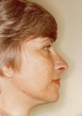 Christopher V. Pelletiere, MD facelift after — Inverness, IL