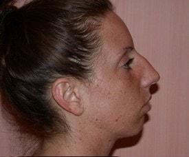 Chin Implant before at Christopher V. Pelletiere, MD in Inverness, IL