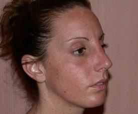 Chin Implant after at Christopher V. Pelletiere, MD in Inverness, IL