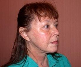 Christopher V. Pelletiere, MD facelift after — Inverness, IL