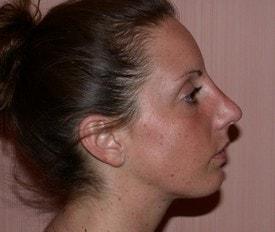 Chin Implant after at Christopher V. Pelletiere, MD in Inverness, IL