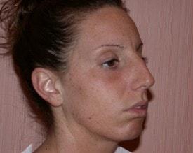 Chin Implant before at Christopher V. Pelletiere, MD in Inverness, IL