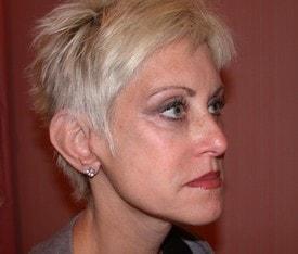 Christopher V. Pelletiere, MD facelift after — Inverness, IL