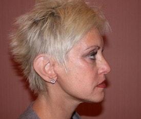 Christopher V. Pelletiere, MD facelift after — Inverness, IL