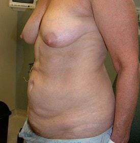 Tummy Tuck before at Christopher V. Pelletiere, MD in Inverness, IL