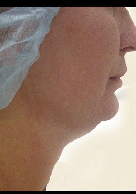 Neck Liposuction before at Artisan Aesthetics Plastic Surgery (Stan Castor, MD) in Tampa, FL