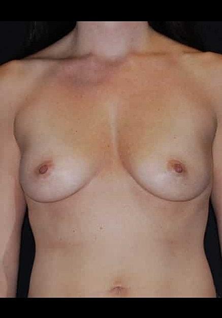 Fat Transfer Breast Augmentation before at Artisan Aesthetics Plastic Surgery (Stan Castor, MD) in Tampa, FL