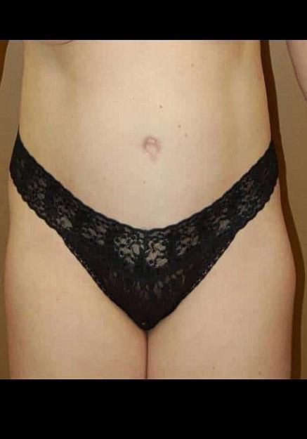Mini Tummy Tuck after at Artisan Aesthetics Plastic Surgery (Stan Castor, MD) in Tampa, FL