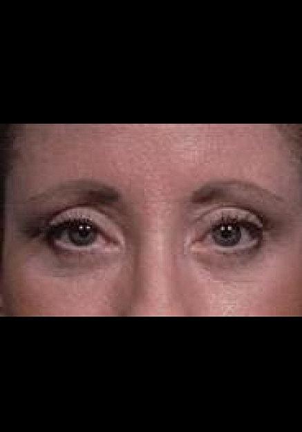 Artisan Aesthetics Plastic Surgery (Stan Castor, MD) eyelid lift after — Tampa, FL