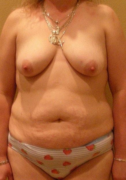 Mommy Makeover before at Artisan Aesthetics Plastic Surgery (Stan Castor, MD) in Tampa, FL