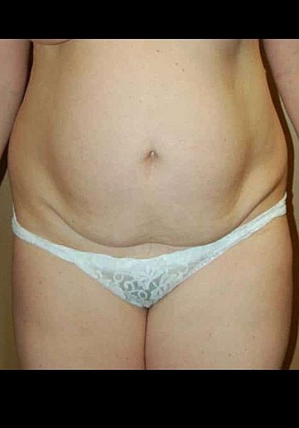 Mini Tummy Tuck before at Artisan Aesthetics Plastic Surgery (Stan Castor, MD) in Tampa, FL