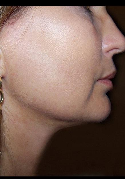 Neck Liposuction after at Artisan Aesthetics Plastic Surgery (Stan Castor, MD) in Tampa, FL