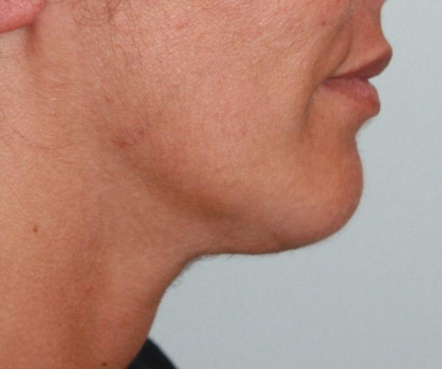 Neck Lift after at Zuliani Facial Aesthetics: Dr. Giancarlo F. Zuliani, MD in Bloomfield Hills, MI
