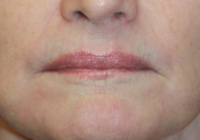 Laser Skin Resurfacing after at Zuliani Facial Aesthetics: Dr. Giancarlo F. Zuliani, MD in Bloomfield Hills, MI
