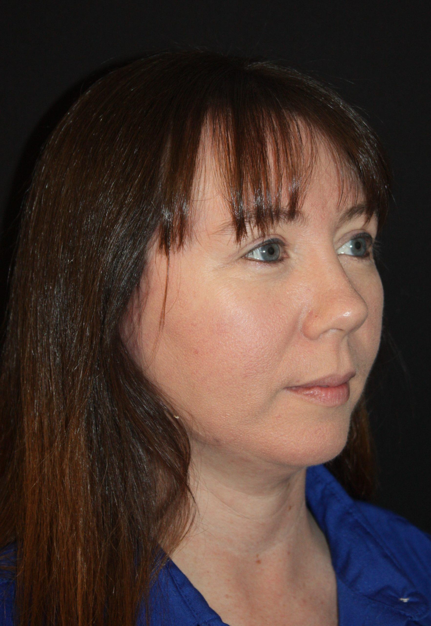 Zuliani Facial Aesthetics: Dr. Giancarlo F. Zuliani, MD facelift after — Bloomfield Hills, MI