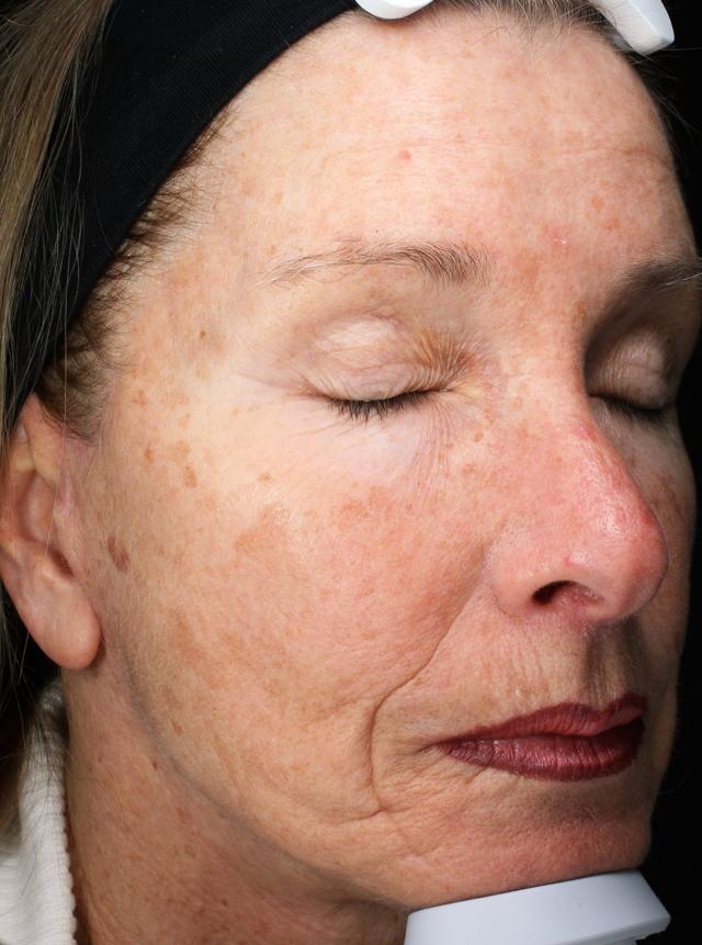 Chemical Peel before at Zuliani Facial Aesthetics: Dr. Giancarlo F. Zuliani, MD in Bloomfield Hills, MI