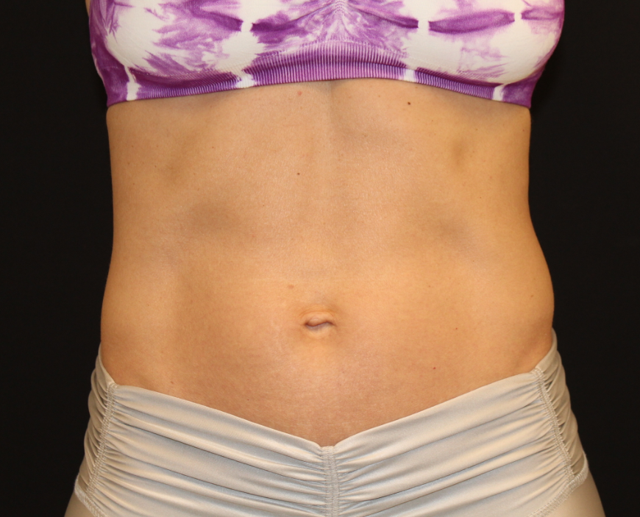 Thigh Lift after at Zuliani Facial Aesthetics: Dr. Giancarlo F. Zuliani, MD in Bloomfield Hills, MI