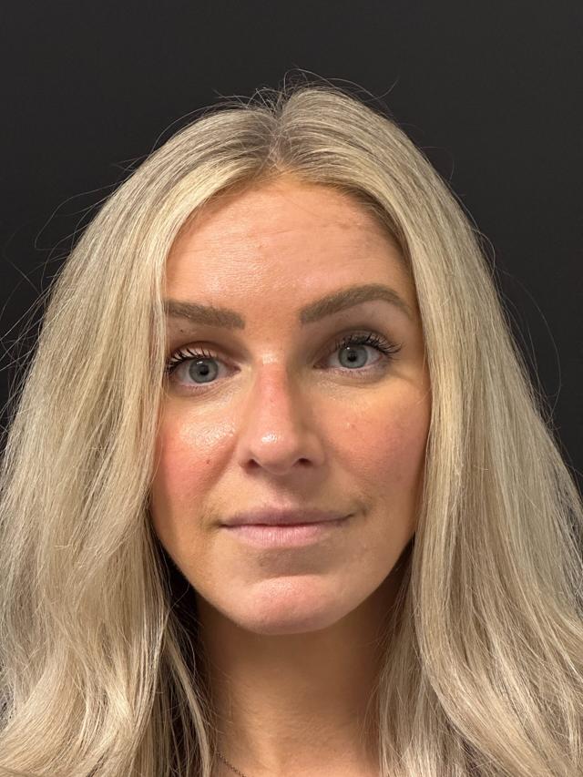 Botox after at Zuliani Facial Aesthetics: Dr. Giancarlo F. Zuliani, MD in Bloomfield Hills, MI