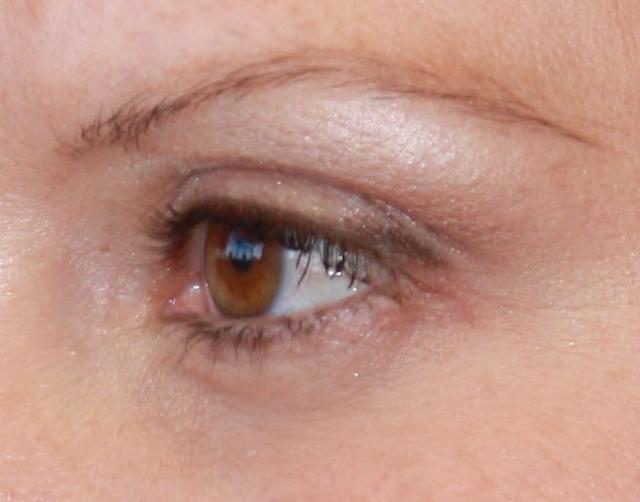 Dermal Fillers after at Zuliani Facial Aesthetics: Dr. Giancarlo F. Zuliani, MD in Bloomfield Hills, MI