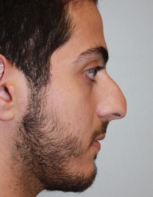 Functional Rhinoplasty before at Zuliani Facial Aesthetics: Dr. Giancarlo F. Zuliani, MD in Bloomfield Hills, MI