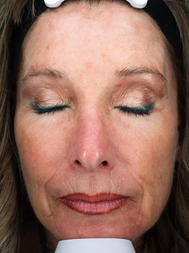 Chemical Peel after at Zuliani Facial Aesthetics: Dr. Giancarlo F. Zuliani, MD in Bloomfield Hills, MI