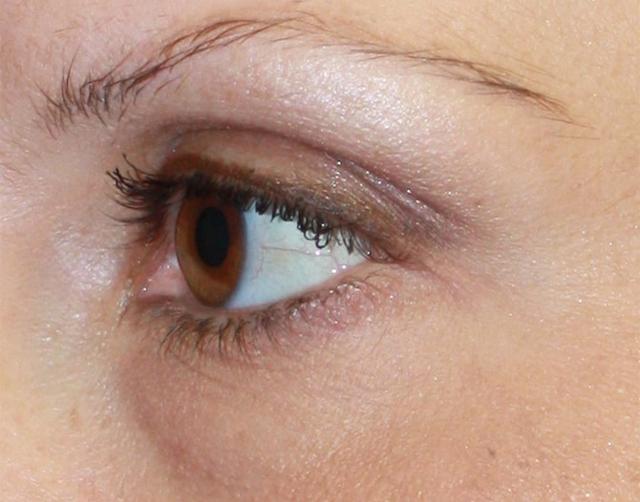 Dermal Fillers before at Zuliani Facial Aesthetics: Dr. Giancarlo F. Zuliani, MD in Bloomfield Hills, MI