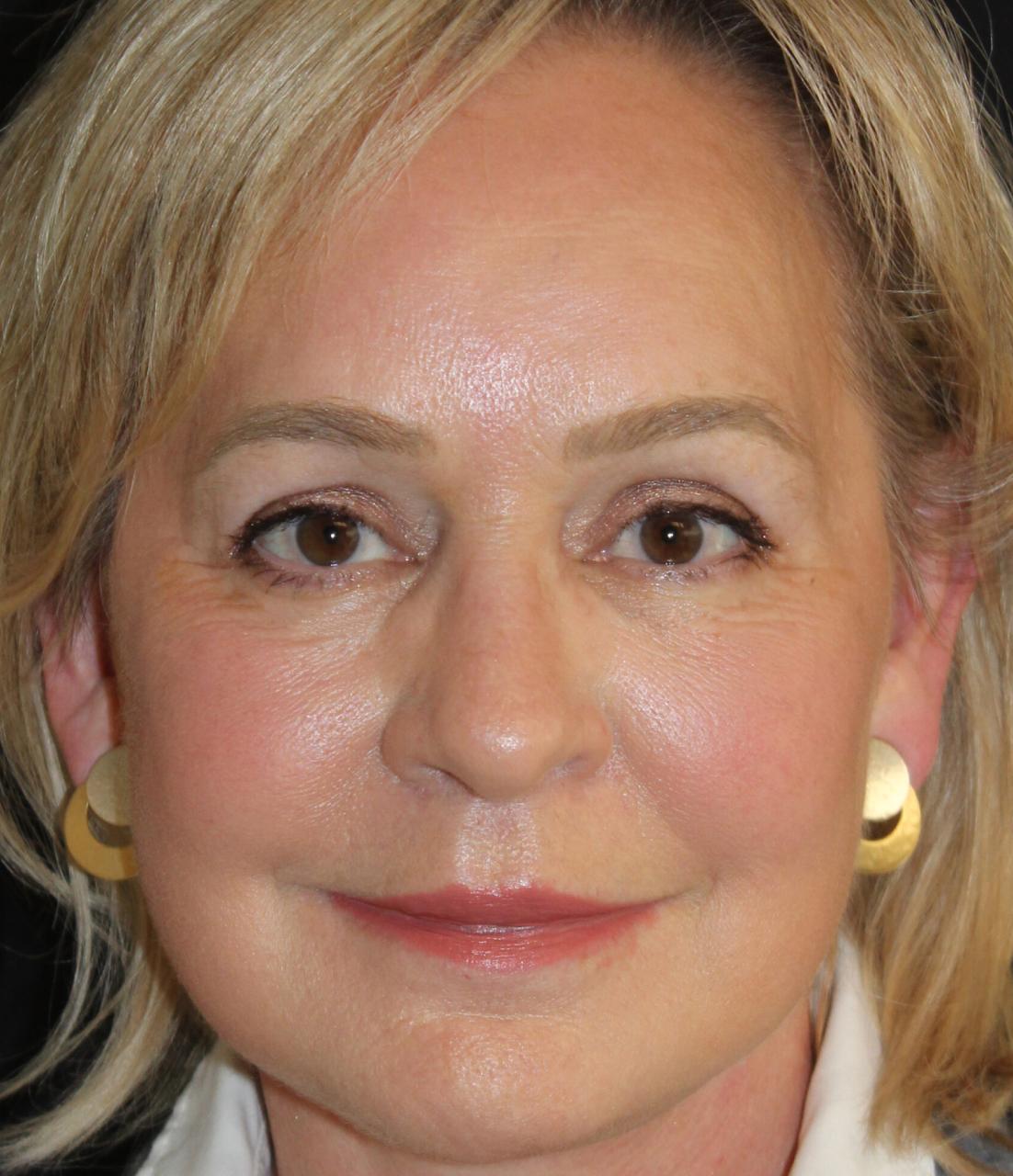 Zuliani Facial Aesthetics: Dr. Giancarlo F. Zuliani, MD facelift after — Bloomfield Hills, MI
