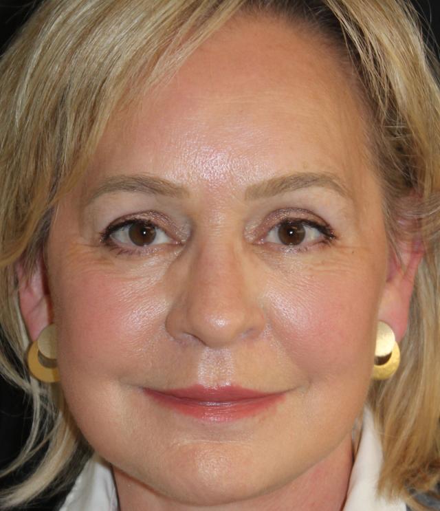 Facelift after at Zuliani Facial Aesthetics: Dr. Giancarlo F. Zuliani, MD in Bloomfield Hills, MI