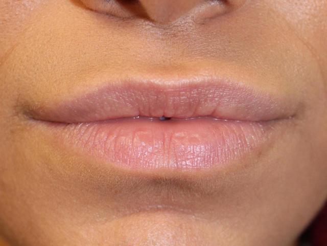 Dermal Fillers after at Zuliani Facial Aesthetics: Dr. Giancarlo F. Zuliani, MD in Bloomfield Hills, MI