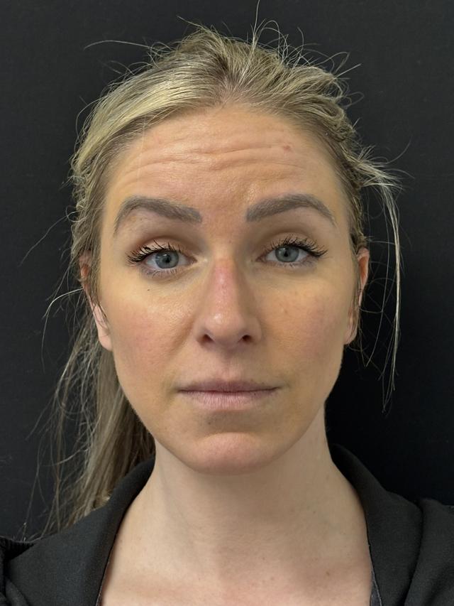 Botox before at Zuliani Facial Aesthetics: Dr. Giancarlo F. Zuliani, MD in Bloomfield Hills, MI