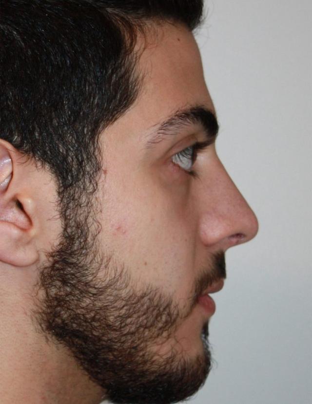 Functional Rhinoplasty after at Zuliani Facial Aesthetics: Dr. Giancarlo F. Zuliani, MD in Bloomfield Hills, MI