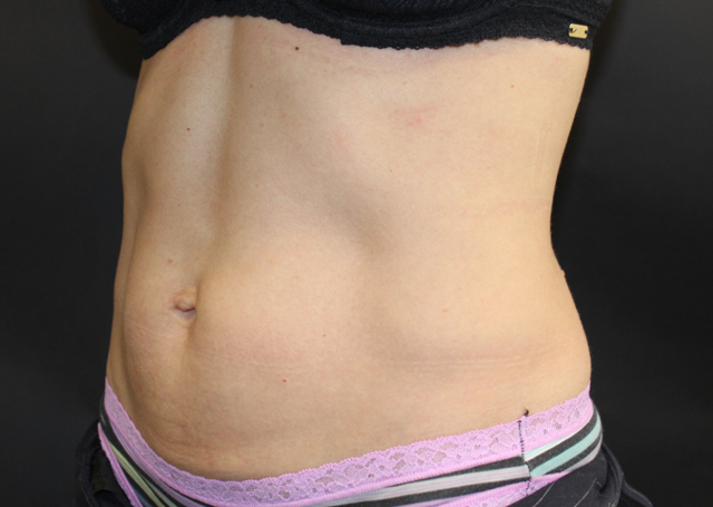 Thigh Lift before at Zuliani Facial Aesthetics: Dr. Giancarlo F. Zuliani, MD in Bloomfield Hills, MI