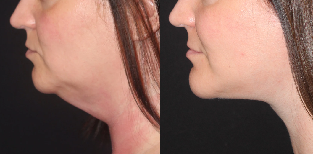 Zuliani Facial Aesthetics: Dr. Giancarlo F. Zuliani, MD fat transfer result — Bloomfield Hills, MI