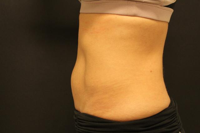 Arm Lift before at Zuliani Facial Aesthetics: Dr. Giancarlo F. Zuliani, MD in Bloomfield Hills, MI