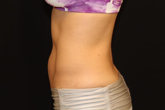 Arm Lift after at Zuliani Facial Aesthetics: Dr. Giancarlo F. Zuliani, MD in Bloomfield Hills, MI