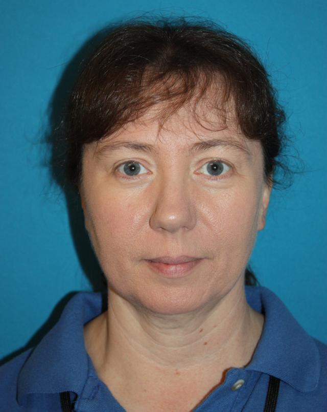 Facelift before at Zuliani Facial Aesthetics: Dr. Giancarlo F. Zuliani, MD in Bloomfield Hills, MI