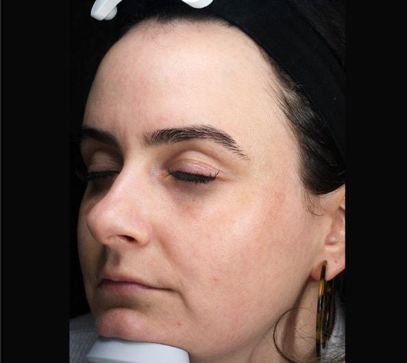 Laser Skin Resurfacing after at Zuliani Facial Aesthetics: Dr. Giancarlo F. Zuliani, MD in Bloomfield Hills, MI