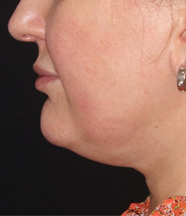 Neck Lift before at Zuliani Facial Aesthetics: Dr. Giancarlo F. Zuliani, MD in Bloomfield Hills, MI